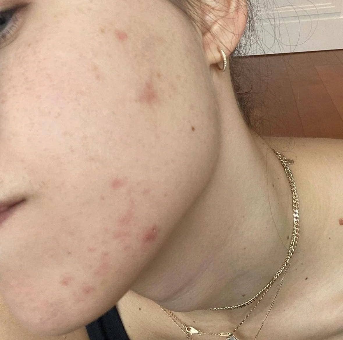 Meghan Swidler's cheek and jawline with active cystic acne, September 2021